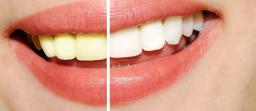 teeth whitening templestowe