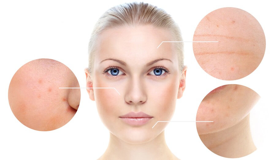 Chemical Peel Benefits For Your Skin
