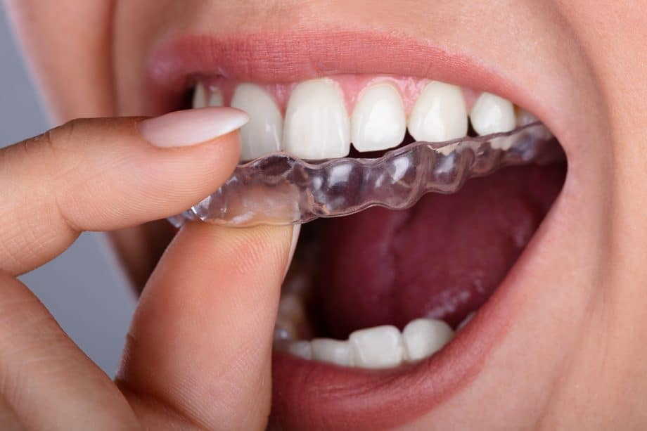 Invisalign