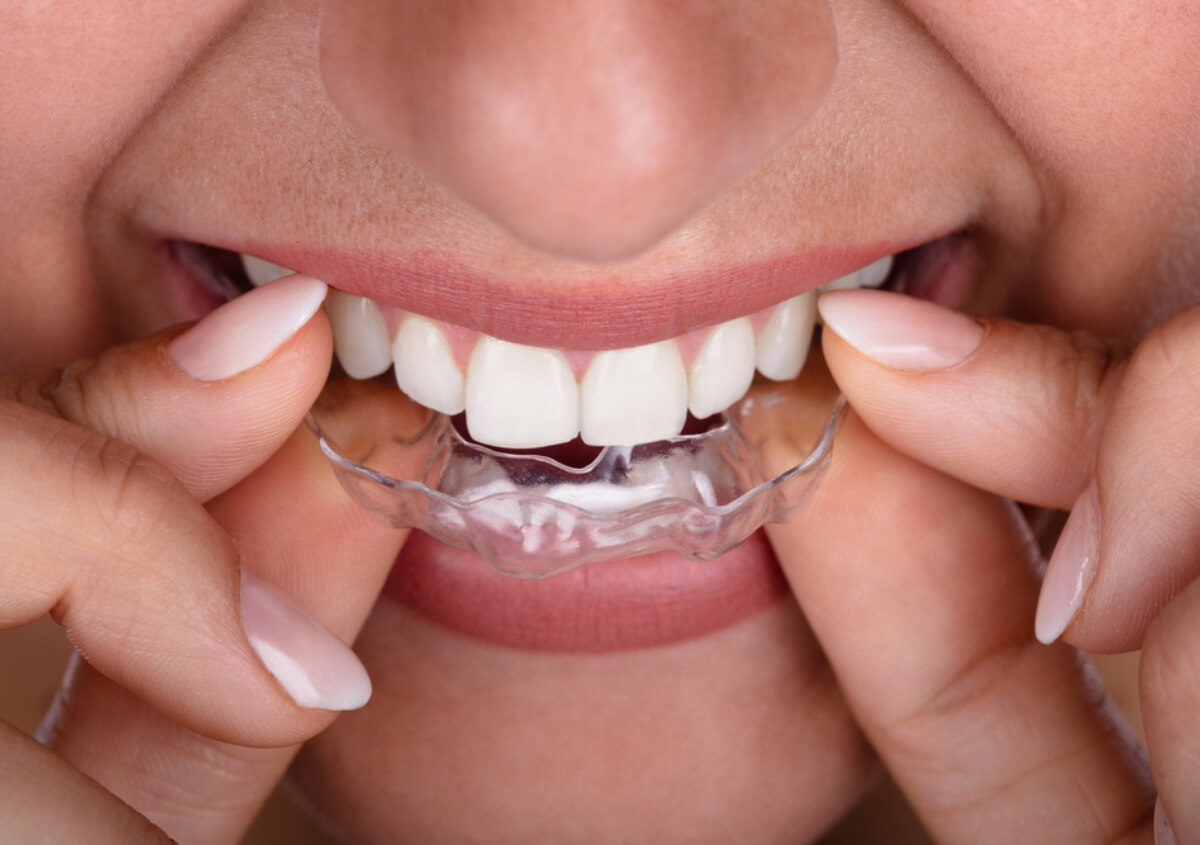 Invisalign Provider in Palmdale
